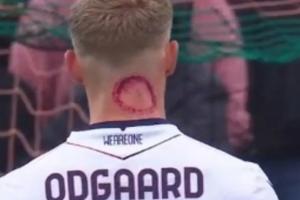 被僵尸咬了？奥德加德脖子现恐怖红斑，赛后回应是脖子用的药